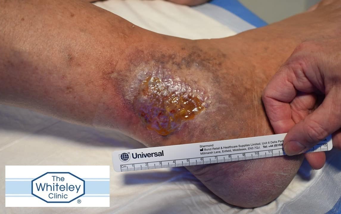 Venous leg ulcer due to "cosmetic" varicose veins being diagnosed as "only cosmetic" and therefore not treated for 20 years