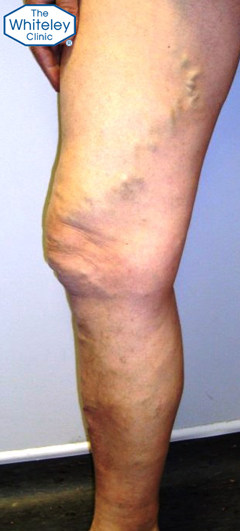 Thigh and calf varicose veins CEAP-C2