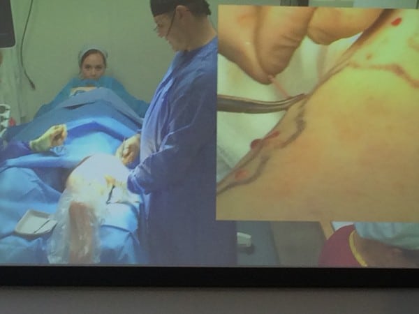 Prof Mark Whiteley operating live teaching EVLT for Varicose Veins