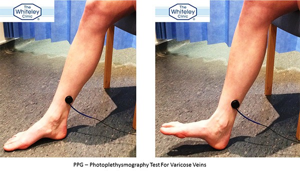 Photoplethysmography (PPG) technique - how PPG is performed to show venous reflux and varicose veins