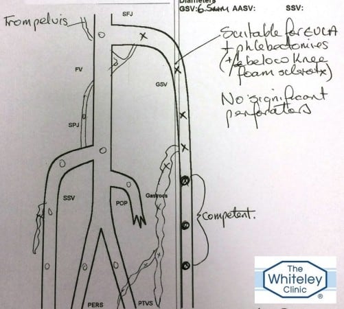 Duplex Ultrasound Report right varicose veins