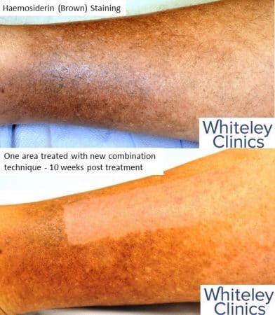 Brown stains on lower leg - haemosiderin - before and after new combination treatment at The Whiteley Clinic - Available Jan 2019