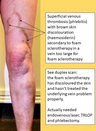 Beware cheap varicose veins treatment - foam sclerotherapy giving inadequate treatment