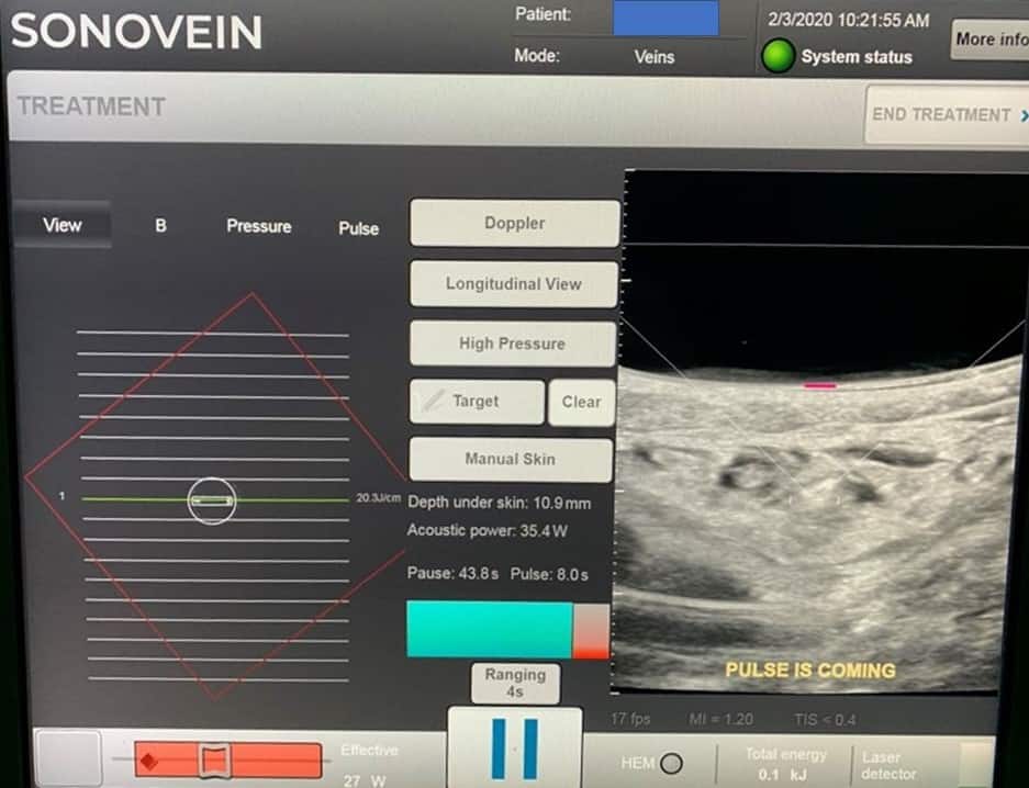 Sonovein screen showing how a surgeon can use the Sonovein HIFU screen to treat varicose veins non-invasively