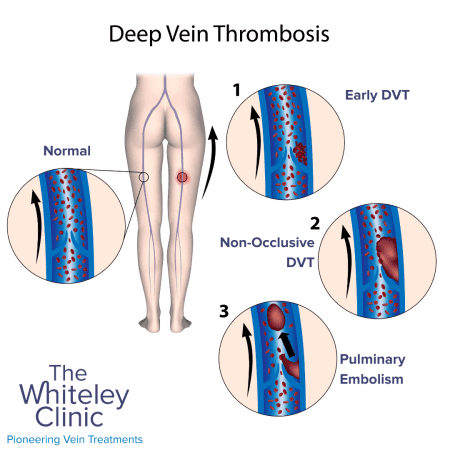 A Diagram showing formation of DVT