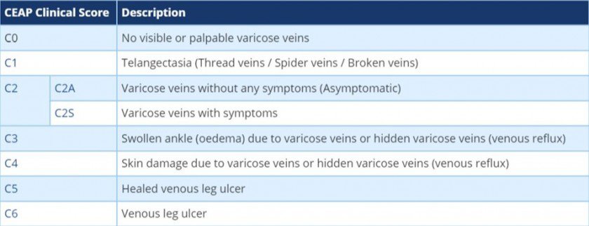Leg veins assessement - assess you varicose veins thread veins spider veins on the self assessment pages of The Whiteley Clinic website