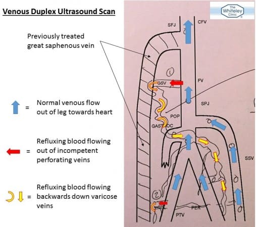 Venous Duplex Ultrasound scan showing incompetent perforator veins causing recurrent varicose veins and ankle oedema CEAP C3