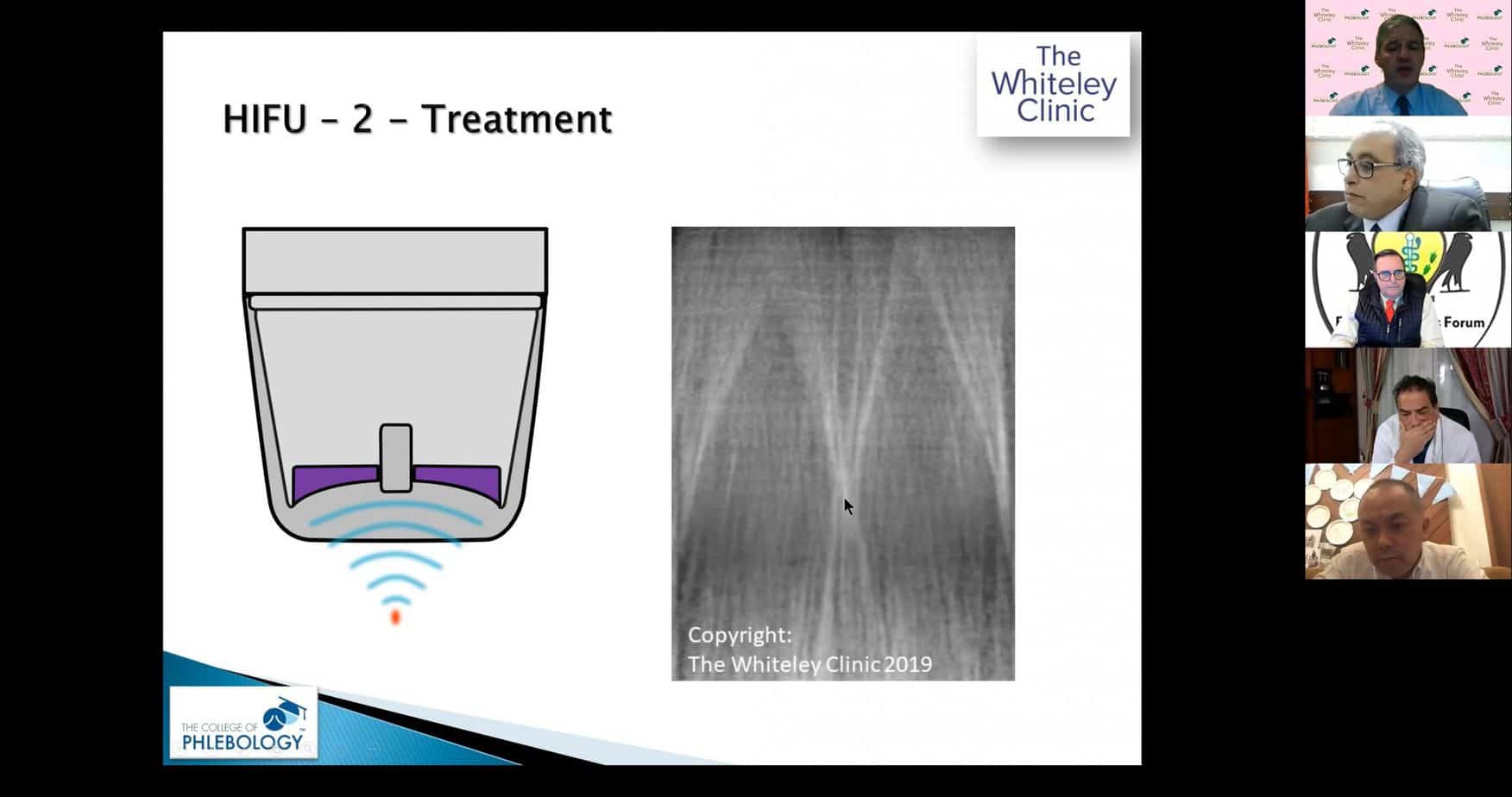 HIFU Echotherapy non-invasive ablation of varicose veins
