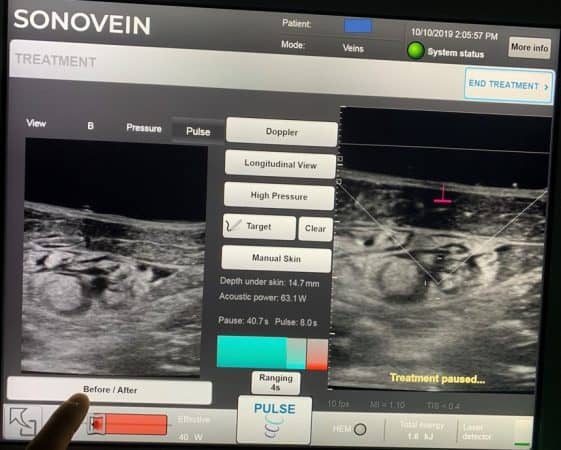 HIFU Echotherapy for Varicose Veins using Sonovein at The Whiteley Clinic course 10 Oct 2019 (2)