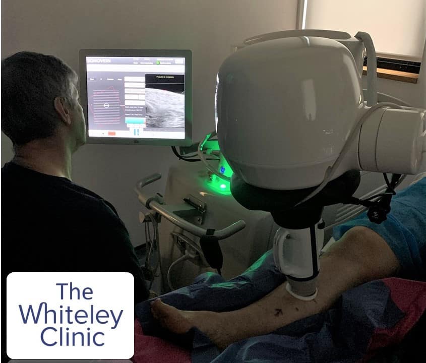 Sonvein S treatment of varicose veins at The Whiteley Clinic November 2020