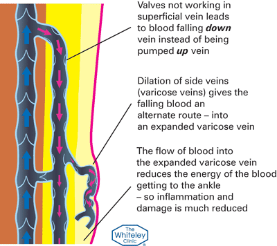 Varicose veins and broken valves diagram