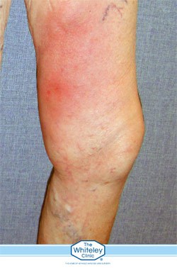Phlebitis shown in a leg
