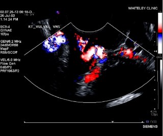 A trans-vaginal duplex ultrasound scan