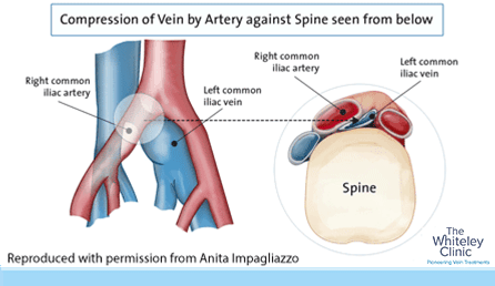 classic-May-Thurner-syndrome-front-and-below