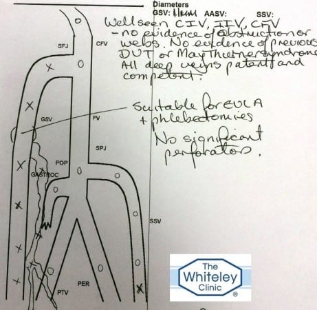 Duplex Ultrasound Report showing hidden varicose veins venous reflux misdiagnosed as lymphoedema