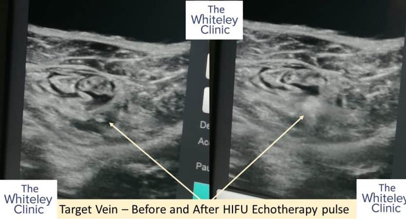 Echotherapy Sonovein treatment of varicose veins at The Whiteley Clinic &ndash; before and after