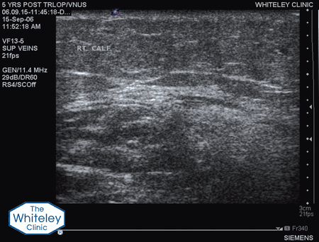 Duplex ultrasound scan showing the site of a previous incompetent perforating vein that has been successfully closed by the TRLOP