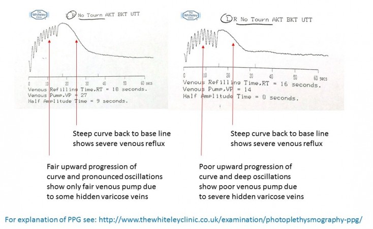 Photoplethysmography PPG showing venous reflux for hidden varicose veins