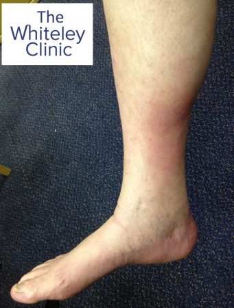 Lipodermatosclerosis &ndash; LDS- of the right leg &ndash; due to hidden varicose veins Whiteley Clinic