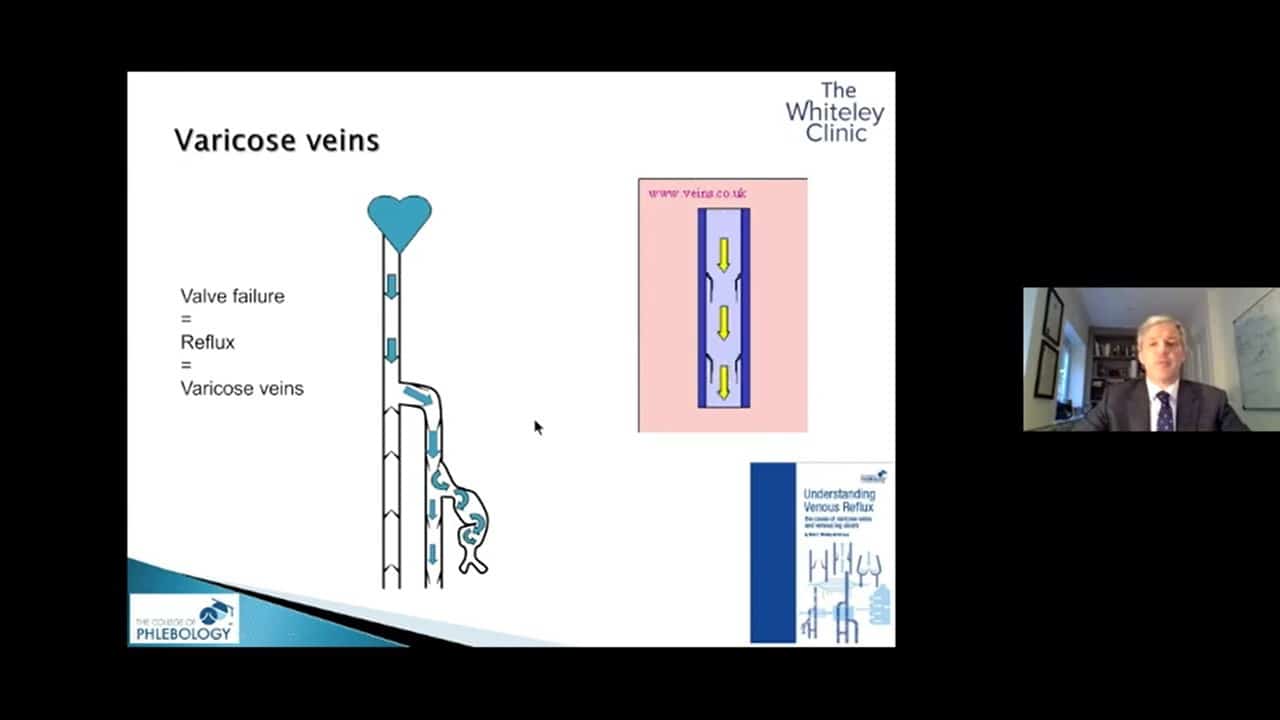 Understandng varicose veins treatments – Theraclion webinar run by Mark Whiteley 23 April 2020