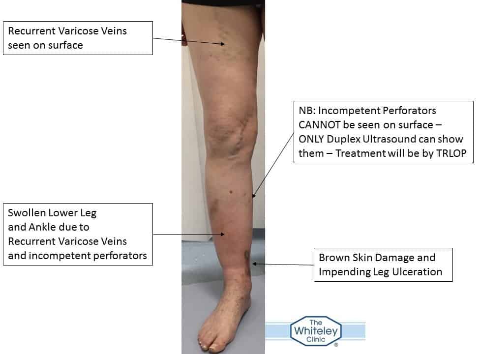 Impending leg ulcer secondary to recurrent varicose veins and perforators