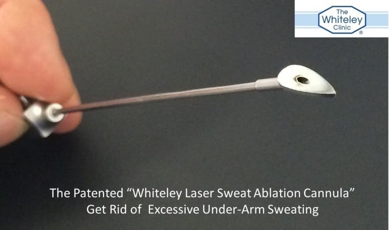 The Patented "Whiteley Laser Sweat Ablation Cannula" improves LSA to Stop Excessive Under-arm Sweating