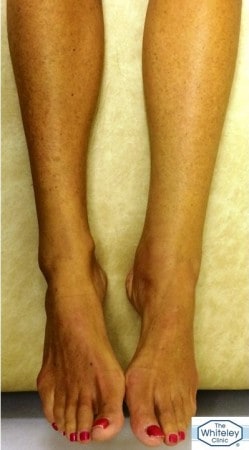 Swollen left ankle due to hidden varicose veins venous reflux misdiagnosed as lymphoedema