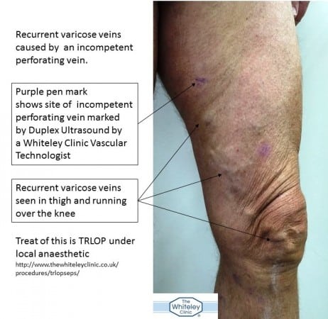 Incompetent perforator vein causing recurrent varicose veins in the thigh