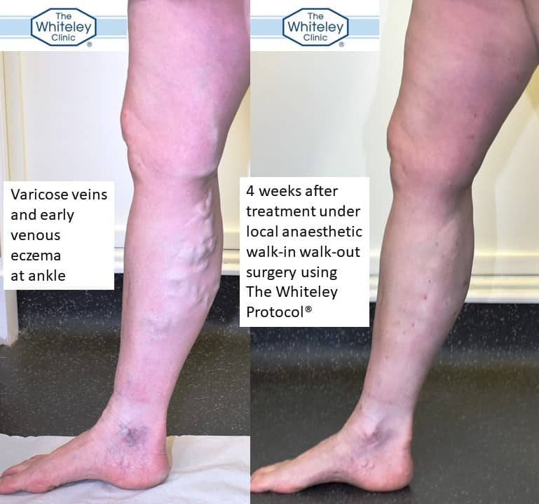 Right leg varicose veins with venous eczema before and after walk-in walk-out local anaesthetic treatment with The Whiteley Protocol