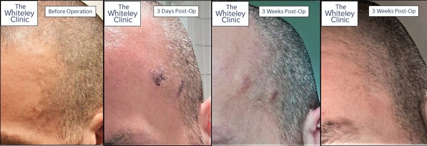 Superfical temporal artery &ndash; double ligation technique first described by Mark Whiteley 2021 Dermatologic Surgery