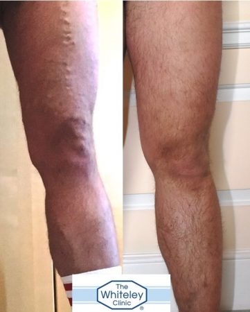 Large varicose veins of left leg in Daniel Foster before and after treatment at The Whiteley Clinic Bristol