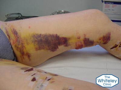 varicose veins stripping - bruising post treatment