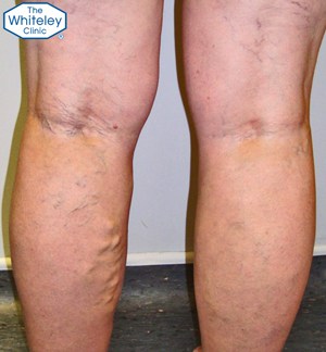 Recurrent varicose veins - CEAP-C2