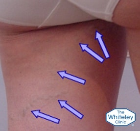 Vulval vaginal varicose veins back of leg