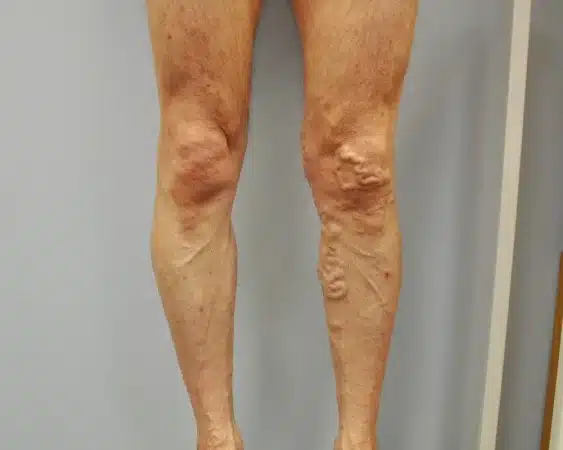 Identifying Tortuous Veins in Clinical Practice