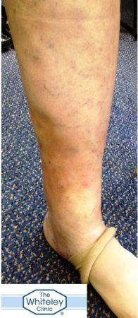 Lipodermatosclerosis LDS secondary to varicose veins CEAP C4 skin damage