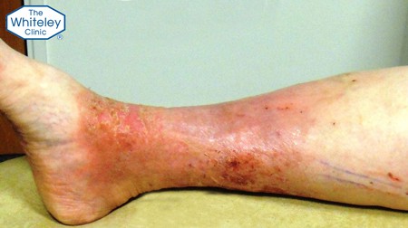 Varicose leg ulcer healed by local anaesthetic EVLT using The Whiteley Protocol&reg; - CEAP-C5