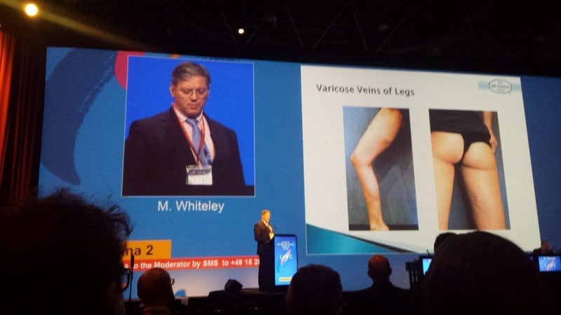 Prof Mark Whiteley lecturing about the link between Pelvic Congestion Syndrome and varicose veins of legs vulva and vagina at LINC in Leipzig 2016