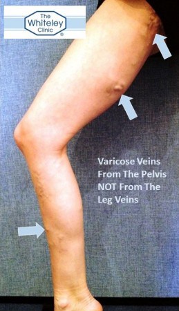 Varicose veins from the pelvis - The Whiteley Clinic is a world leading clinic in treating pelvic varicose veins