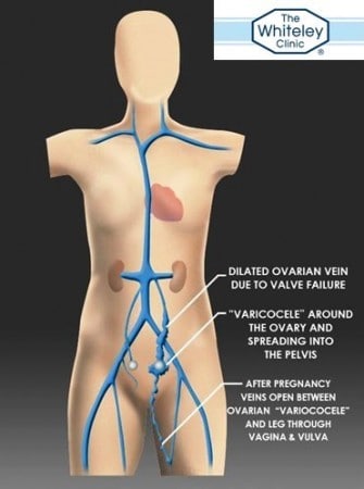Ovarian vein reflux - a cause of pelvic varicose veins or "pelvic congestion" - best test is Transvaginal Duplex Ultrasound (TVS)