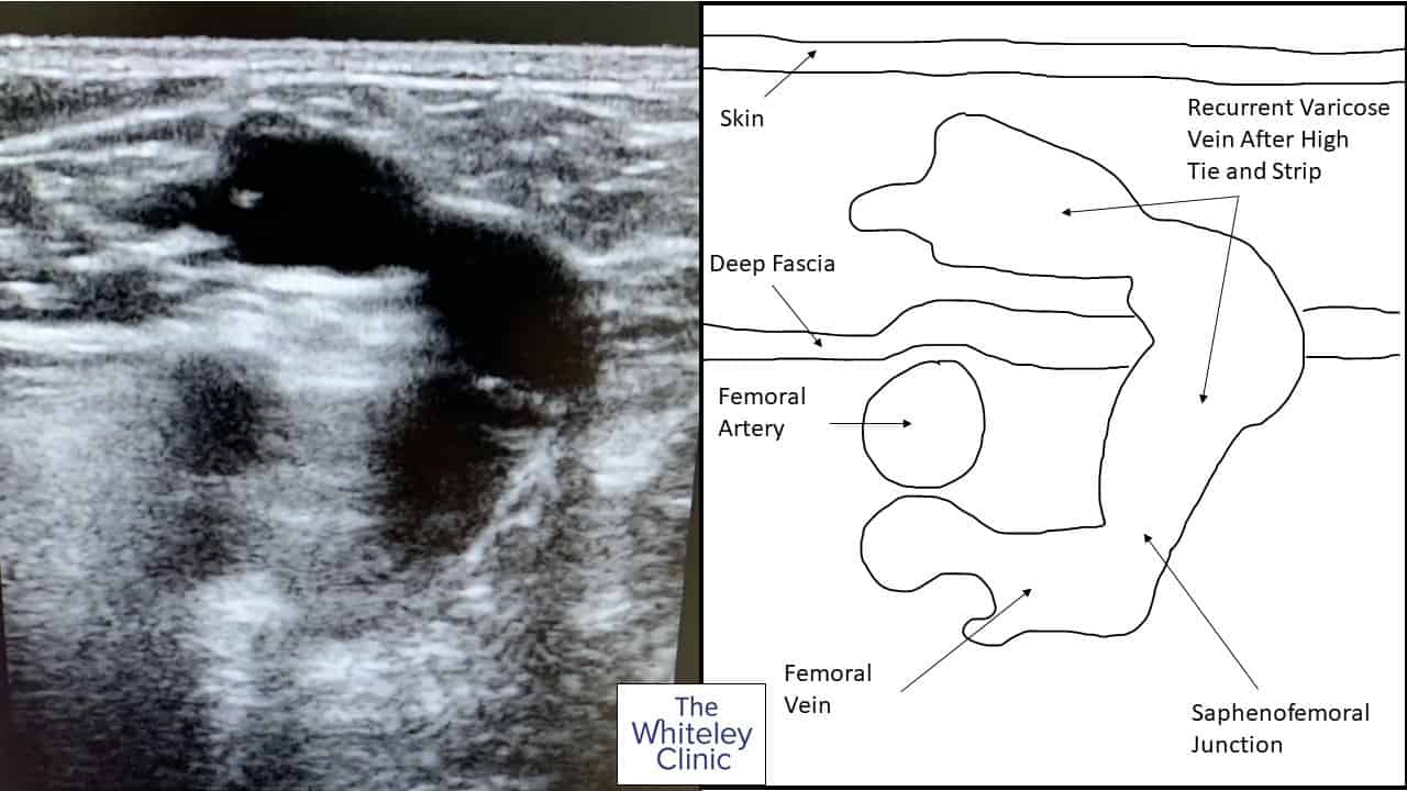 HIFU treatment of recurrent varicose veins &ndash; the recurrent stump of the sapheno-femoral junction after a tie and strip on ultrasound