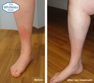 venous eczema treatment - before and after