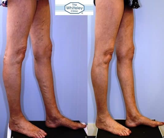 Recurrent varicose veins both after stripping 10 years ago - treated successfully by The Whiteley Protocol - Right