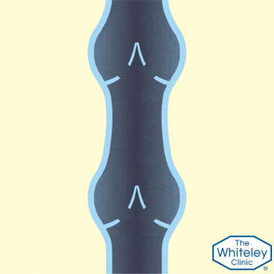 Damaged vein valves causing venous reflux - a cause of varicose veins