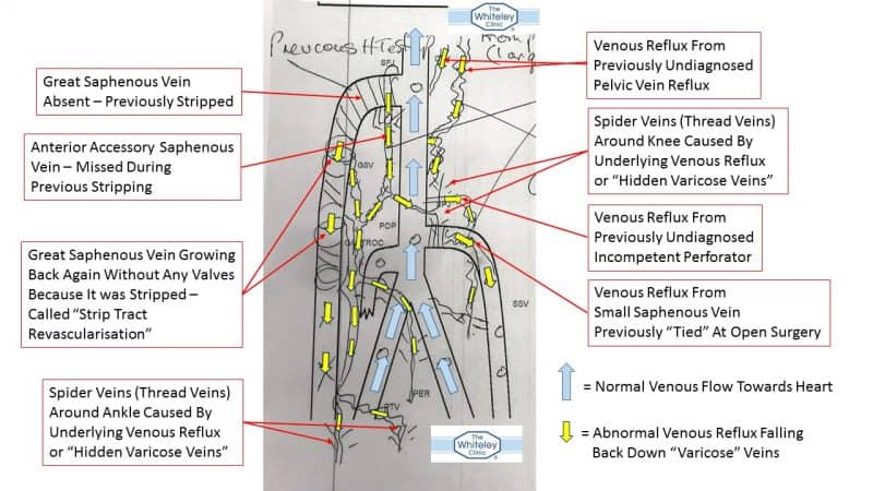 Hidden Varicose Veins causing Spider Veins - Patient should have had duplex ultrasound scan before spider vein treatment