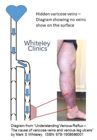 Hidden varicose veins - diagram showing why there are no visible varicose veins on surface on standing in patient with venous skin damage- The Whiteley Clinic