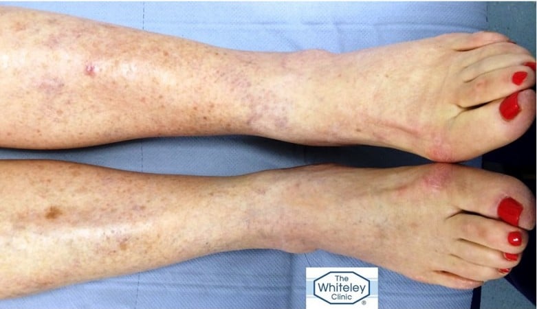 Swollen left ankle CEAP 3 due to hidden varicose veins missed for 10 Years