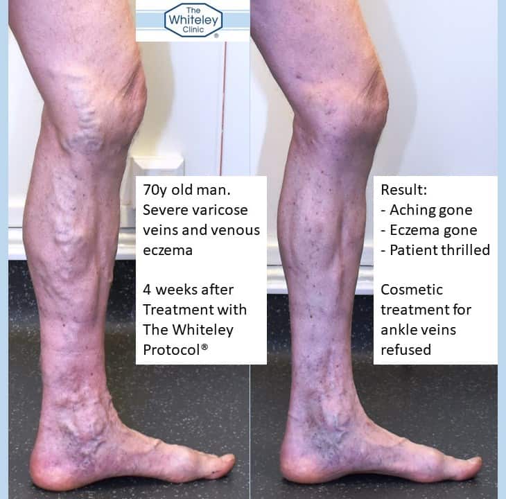 Varicose eczema and varicose veins cured by Whiteley Protocol - Before and after varicose vein surgery 4 weeks later