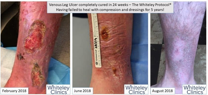 Venous Leg Ulcer cured permanently with Whiteley Protocol having failed to heal with compression for years