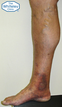 Skin damage due to varicose veins - almost a venous ulcer - CEAP-C4